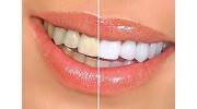 Teeth Whitening