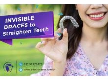 Invisible braces