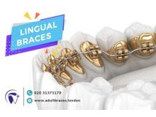 Lingual braces